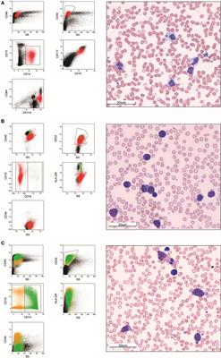Diagnostic challenges in acute monoblastic/monocytic leukemia in children
